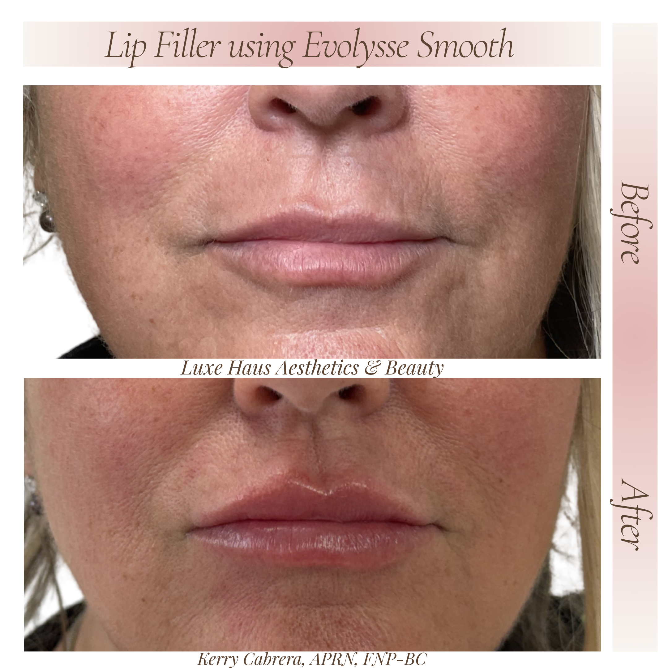 Before Lip Filler 2