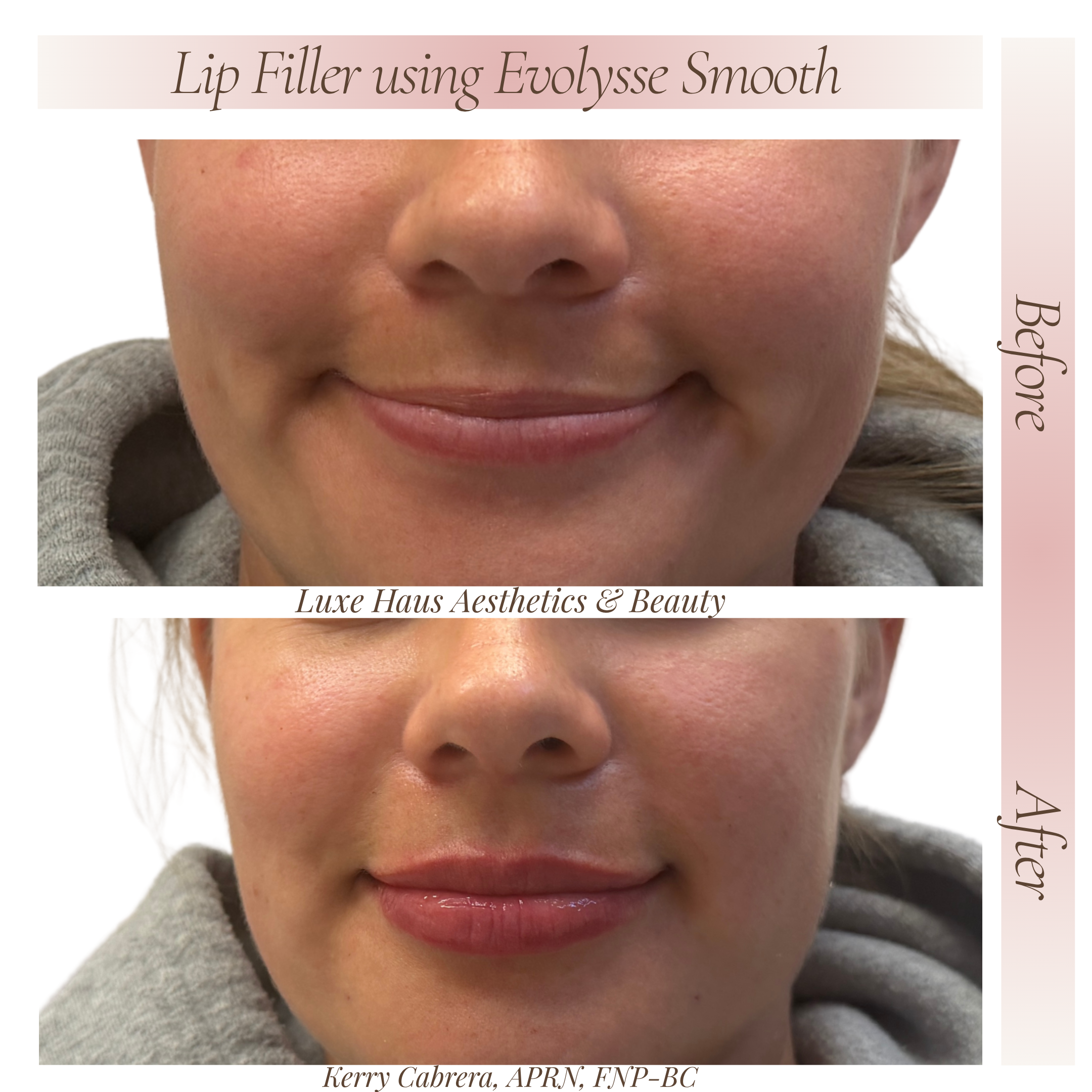 After Lip Filler 2