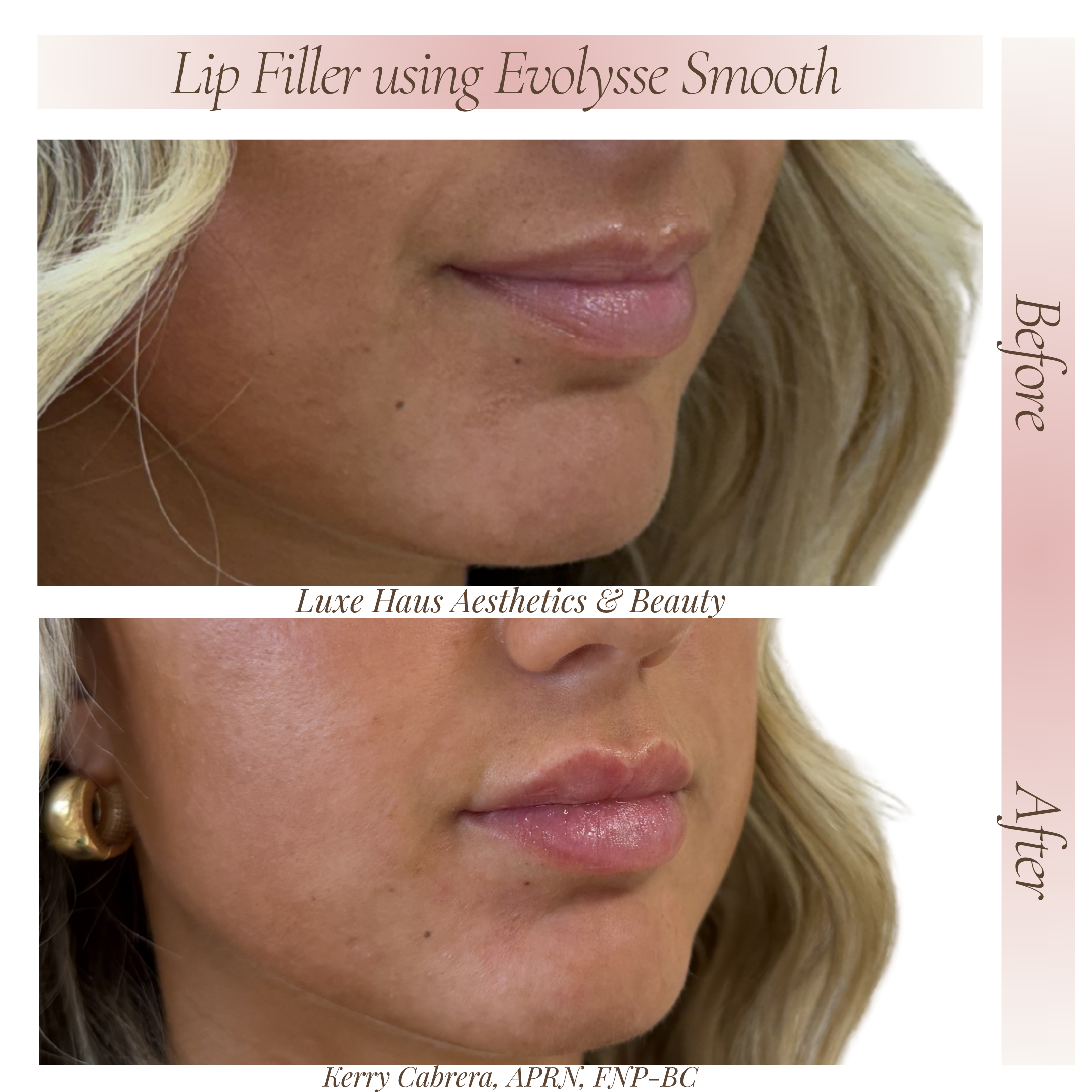 Before Lip Filler 1