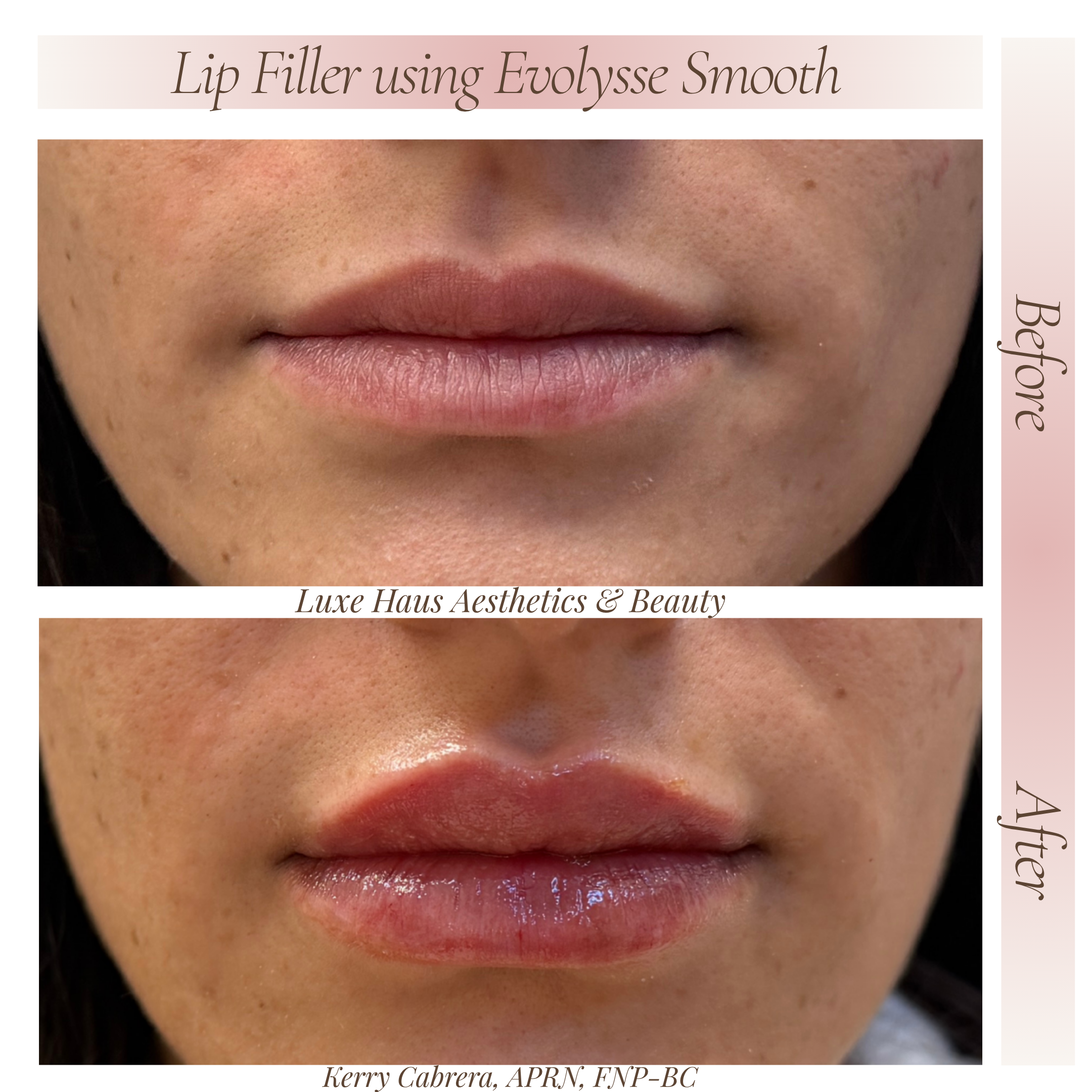 After Lip Filler 1