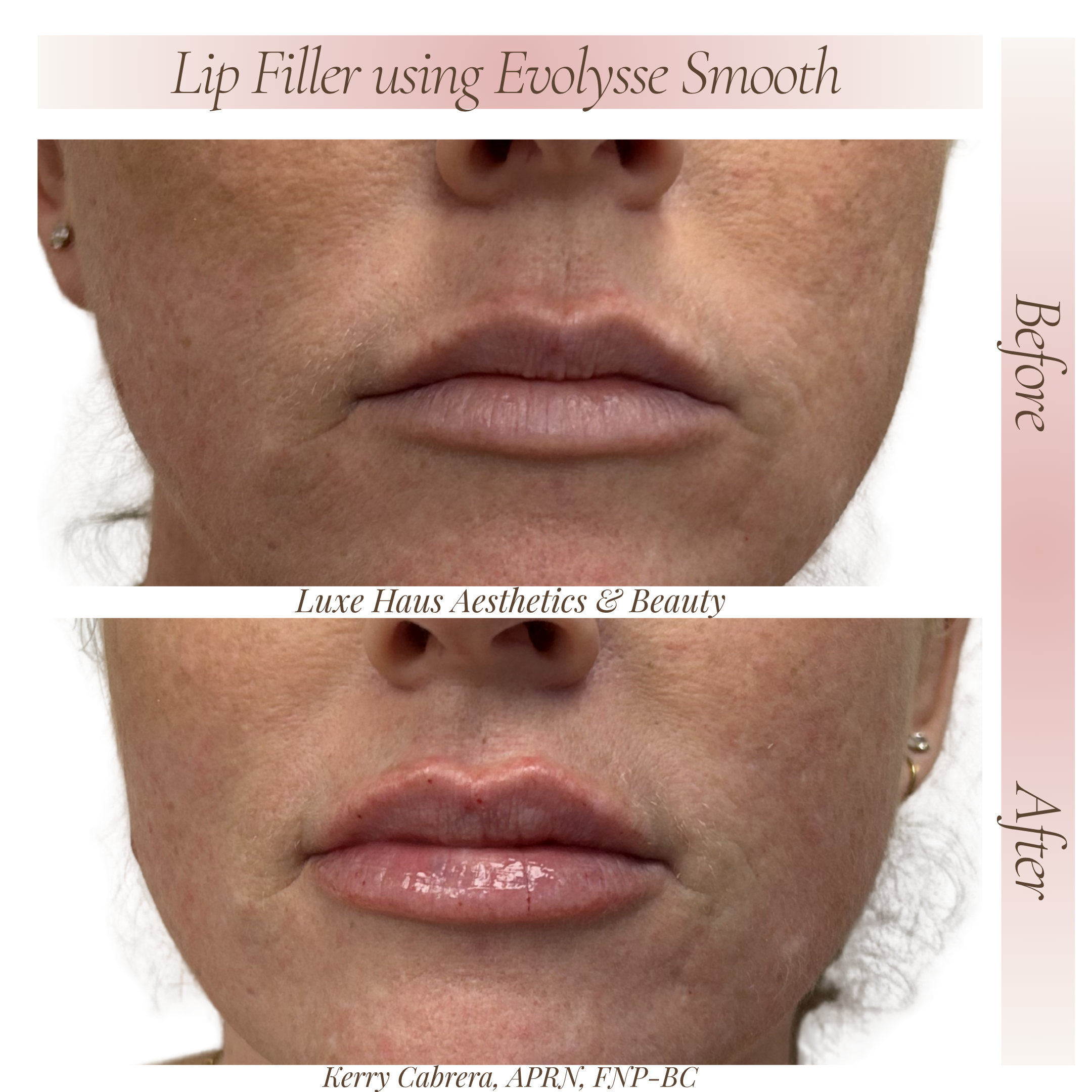 Before Lip Filler 3