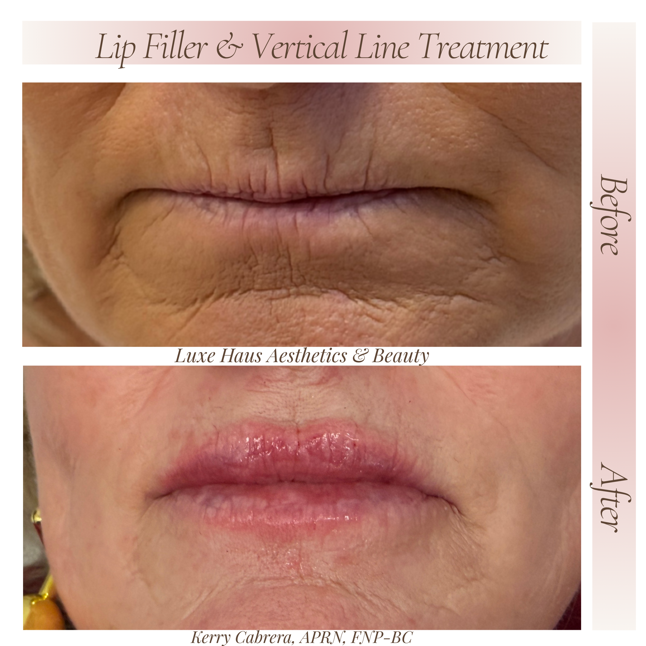 After Lip Filler 3