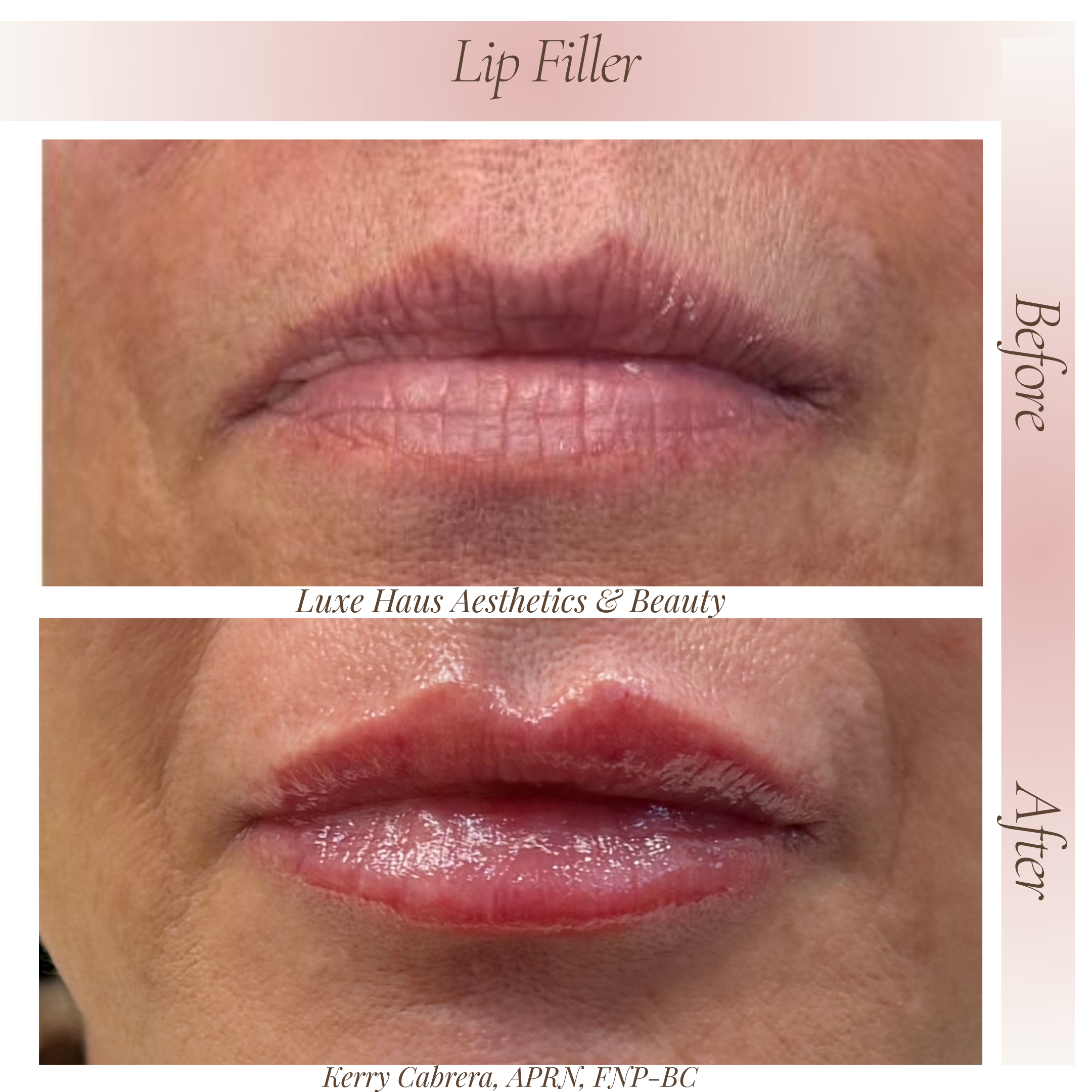 After Lip Filler 4